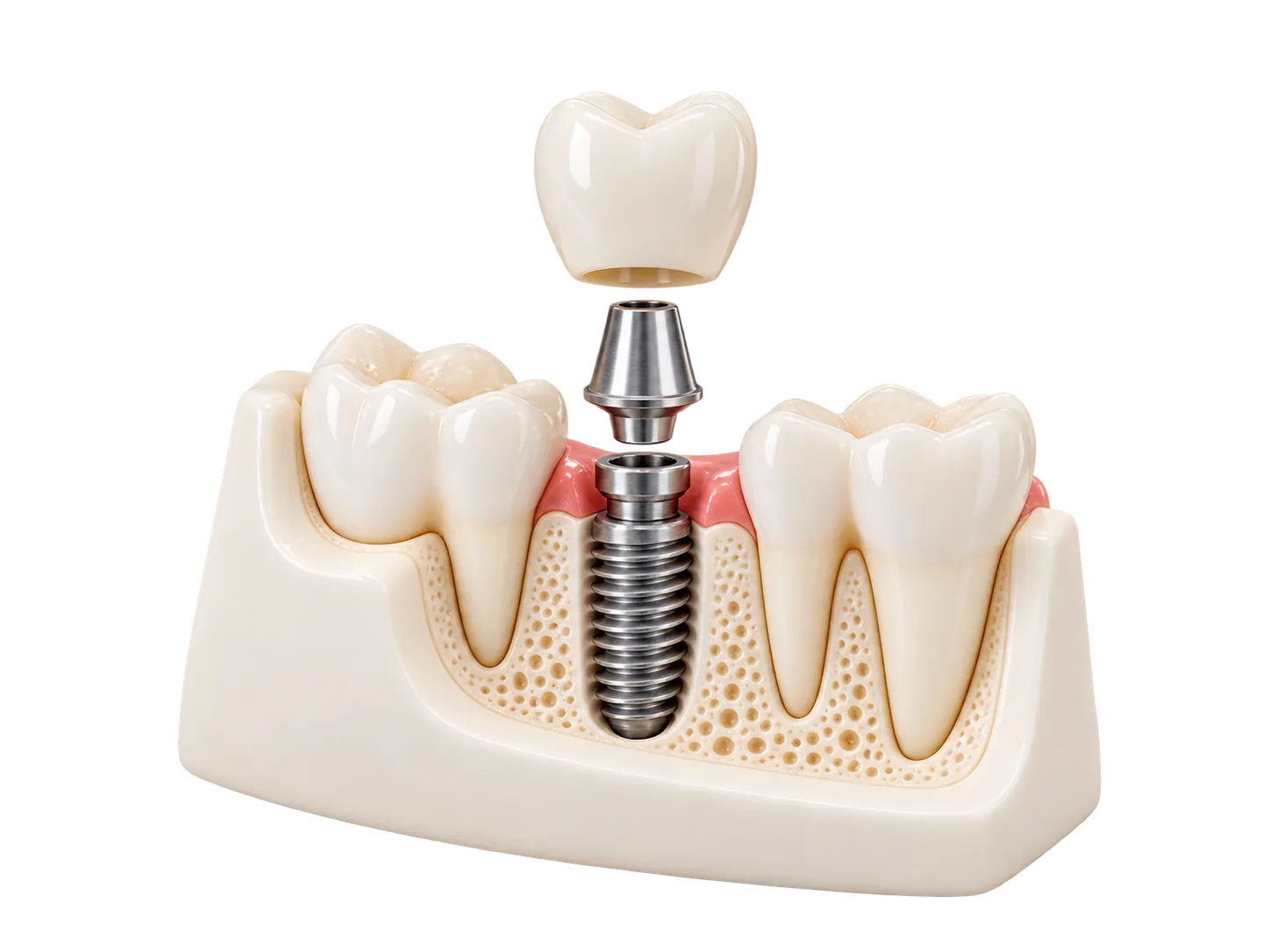 Ilustração de implante e reabilitação dentária
